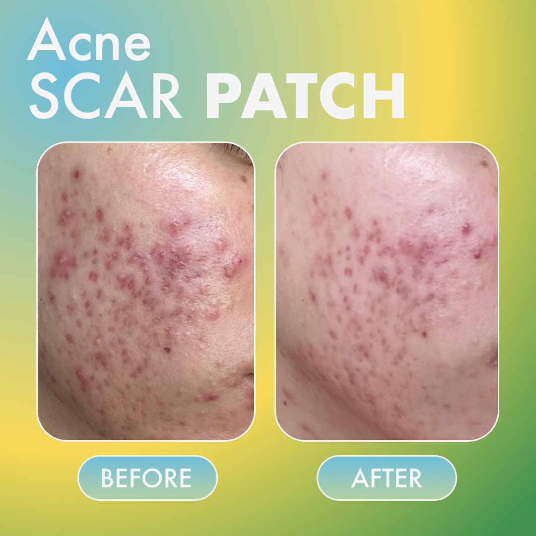 Fazit Acne Scar Patches for face, bikini, and body: 48